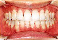 ホワイトニング後の歯